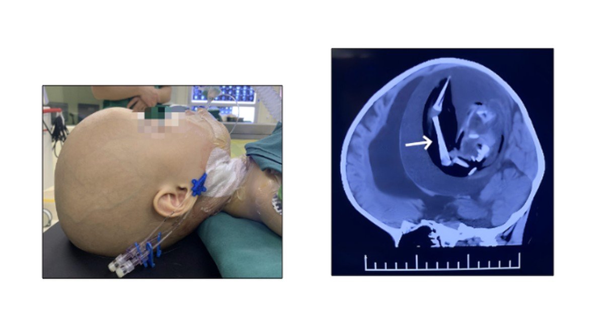 Médicos retiram ‘feto parasita’ de 18 cm de crânio de bebê de 1 ano